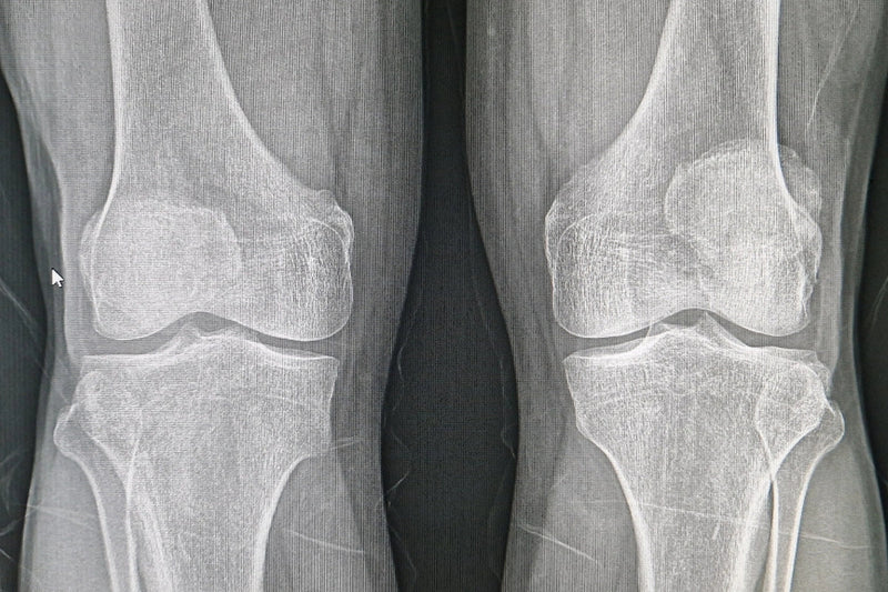 Astounding 10.7% Increase in Bone Density!