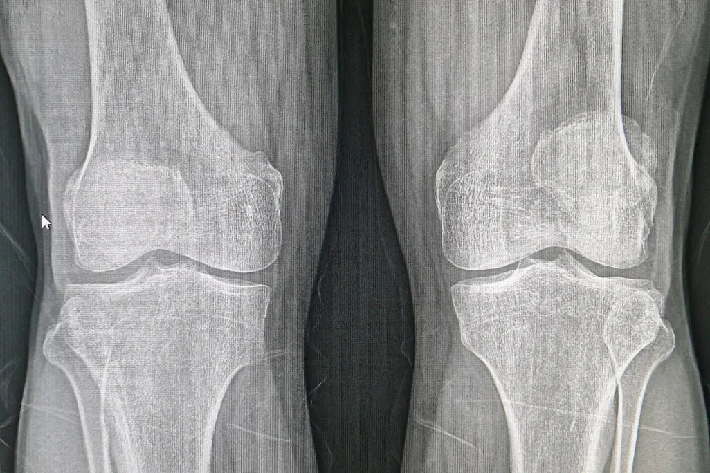 Astounding 10.7% Increase in Bone Density! Umicellar