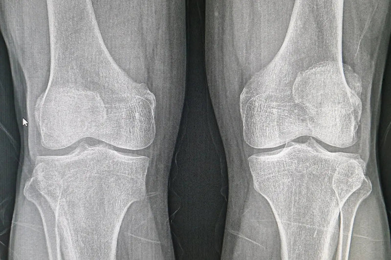 Astounding 10.7% Increase in Bone Density! Umicellar