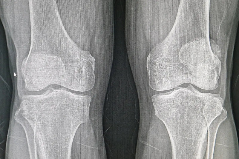 Astounding 10.7% Increase in Bone Density! Umicellar