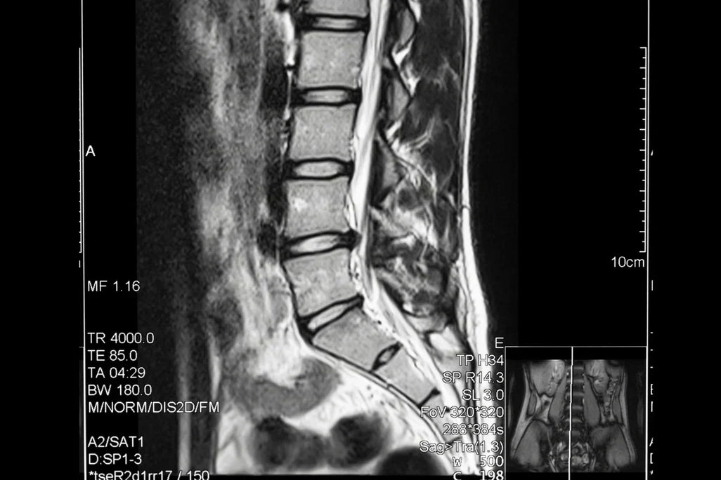 When Surgery Seemed Inevitable: One Patient's Three-Year Journey Without the Operating Room