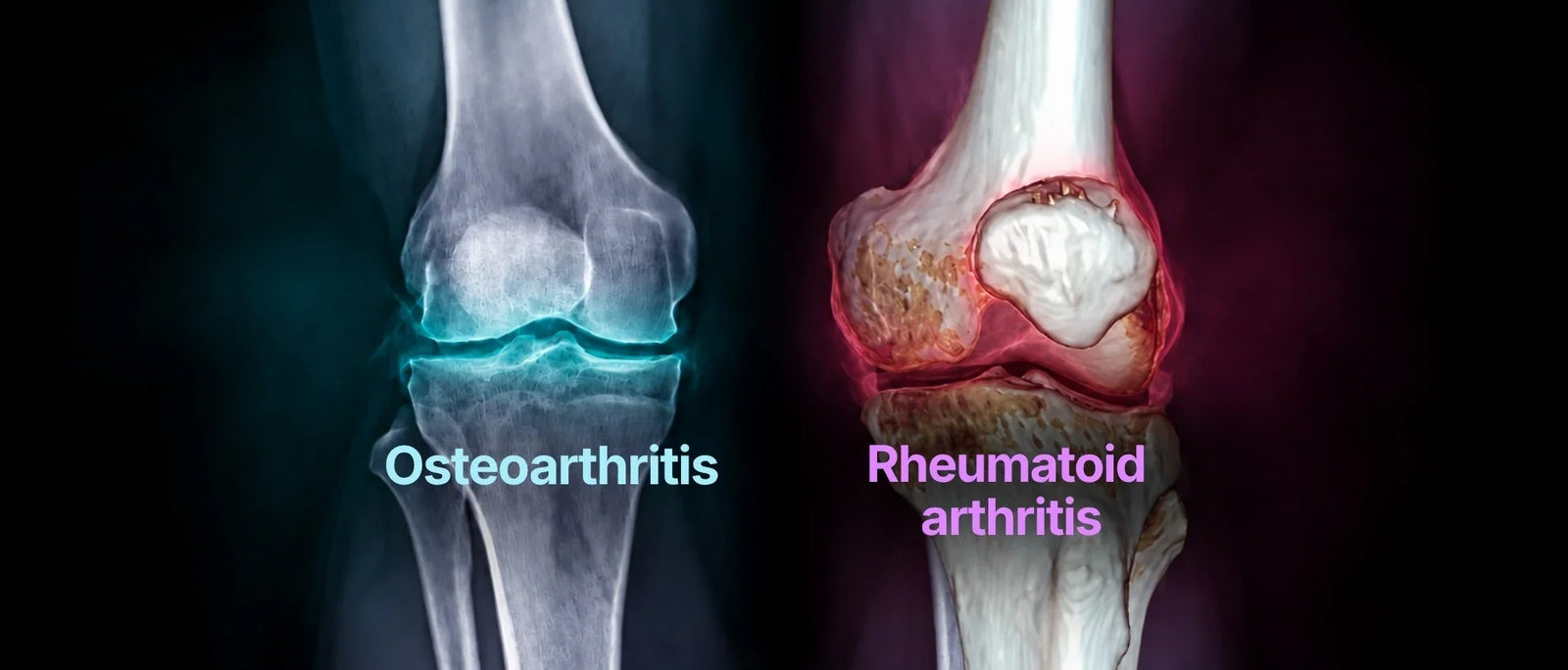 Osteoarthritis vs Rheumatoid Arthritis: How to Tell the Difference