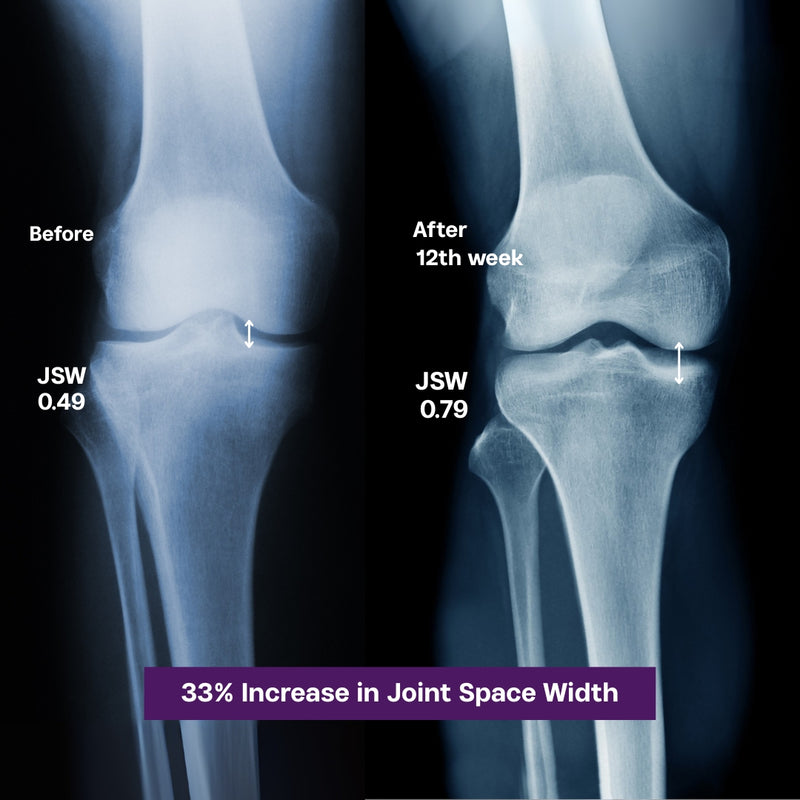 Medial joint space widened over 12 weeks